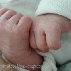 Hamish, August 5th 2014 Peeling skin at birth